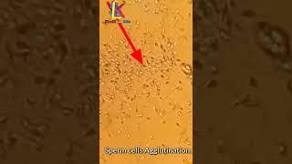 sperm cells agglutination under microscope.