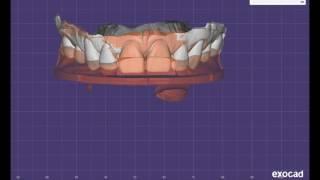 Kois dentofacial analyzer digital transfer technique