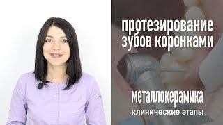 Протезирование зубов металлокерамическими коронками – клинические этапы