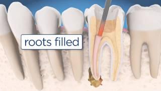 Root Canal Retreatment Explained