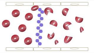 Thrombotic Thrombocytopenic Purpura (TTP) Part 1: Basics