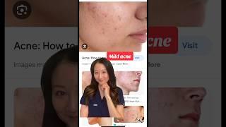 Acne hacks from #dermatologist #skincareroutine #skincaretip #acne #acnetreatment #acnetips #shorts
