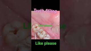 teeth filling  teeth cavity #video