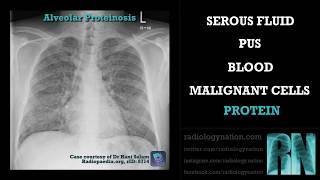 Radiograph Tutorial: Chest X-ray / CXR consolidation | Radiology Nation