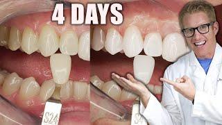Dentist PROVES The BEST TEETH WHITENING Results Are AT HOME (Not the Dentist): Fast, Cheap,  & Safe