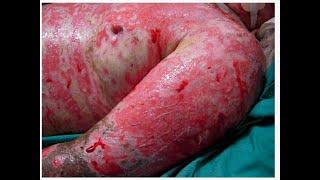 Toxic Epidermal necrolysis/TEN (Causes, clinical feature, investigations management)