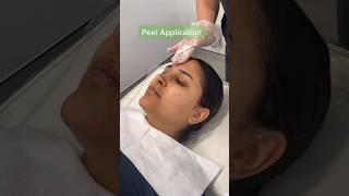 Peeled to Perfection! A step by step Chemical Peel treatment | Results Laser Clinic #chemicalpeel