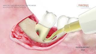 PIEZOSURGERY® - Dr. Fabrizio Fontanella - Impacted third molar extraction technique