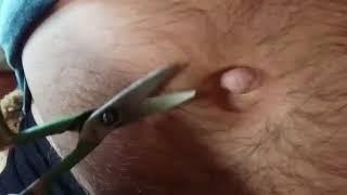 Outie belly button hair trimming