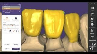 Two Central Incisors with Textures very easy with exocad video tutorial