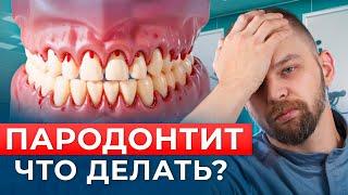 Пародонтит: как лечить и что делать?