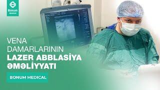 VENA DAMARLARININ LAZER ABBLASİYA ƏMƏLİYYATI - Bonum Medical