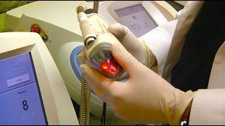Treating Stretch Marks in NJ