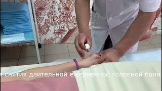 Иглоукалывание против мигрени и хронической головной боли