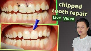 chipped tooth repair | satisfying video