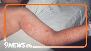 Texas experiencing worst measles outbreak in decades