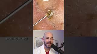 Derm reacts to BIG blackhead removals behind the ear! #dermreacts #doctorreacts #blaclheadextraction