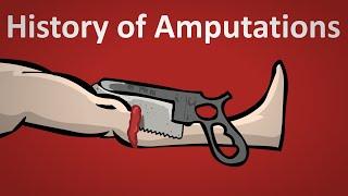 The History of Amputation Explained