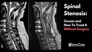 Spinal Stenosis: Causes and How to Treat It Without Surgery