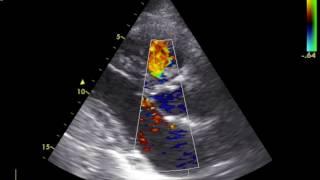 Right ventricular floating mass. What is it? - Dr. Alexandru Mischie