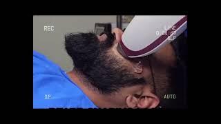 shaping Laser hair reduction treatment#dr Ajay Garg clinic #skincare #likeandsubscribe