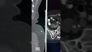 Accessory sacroiliac joint #normal variant #accessorysacroiliacjoint #radiology #anatomicalvariant