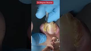 MONSTER INGROWN TOENAILS #shorts #ingrowntoenail