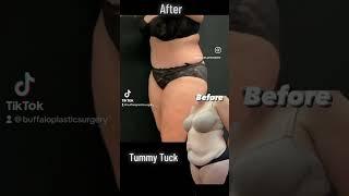 Tummy Tuck (Amazing Transformation)