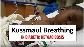 Kussmaul Breathing in Diabetic Ketoacidosis