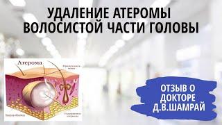 Удаление атеромы волосистой части головы. Отзыв о докторе
