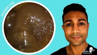 1,495 - Masses of Ear Wax Removed using Microsuction