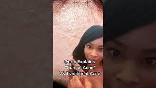 Why those tiny bumps aren't Fungal Acne!