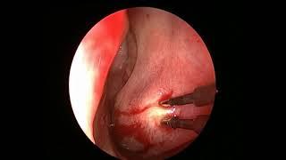 Radiofrequency Turbinoplasty