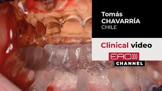 Complete Bimaxillary Rehabilitation & Immediate Loading w/ Tomas Chavarria | EAO Clinical video