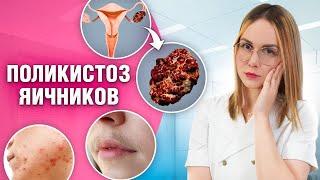 Вся правда о поликистозе яичников: Виды, причины, риски и лечение!