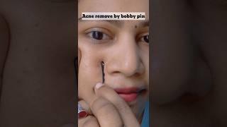 Acne Remove by bobby pin | pimples pop #acne #pimplepopping