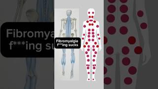 Fibromyalgia trigger points on the superficial back line #fibromyalgia