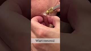 Wart Removal at Oak Dermatology