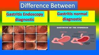 Difference Between Gastritis Endoscopy diagnostic and  normal diagnostic