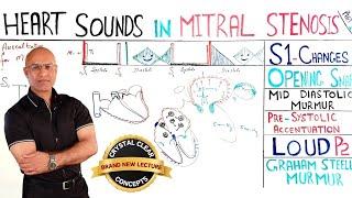 Heart Sounds in Mitral Stenosis | s1 | Cardiology