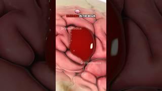 Burr hole drainage (3D Animation)