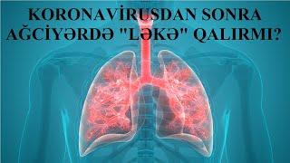 Koronavirusdan sağalanların ağciyərlərində "LƏKƏ" qalırmı? Nələr etməliyik?