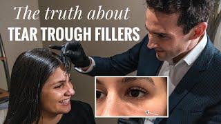 Why tear-trough fillers go wrong 