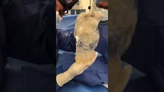 Ruptured Style 45 Breast Implant