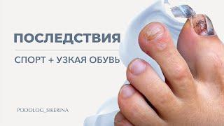 ОТДАВИЛА ПАЛЬЦЫ ОБУВЬЮ НОГОТЬ ОТОШЁЛ ОТ ЛОЖА