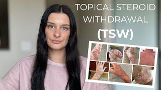 Topical Steroid Withdrawal (TSW) | WATCH THIS BEFORE USING TOPICAL STEROIDS | Dr. Sienna Miller, ND