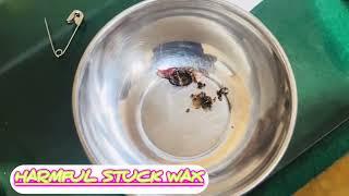 Deeply and firmly stuck harmful Ear Wax removed successfully in a distressed lady.