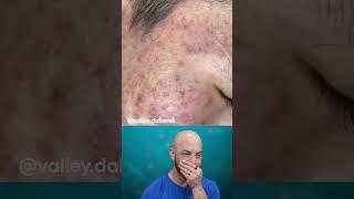 This person needs to get on Accutane pronto! (credit: @valley.dalterak on TT) #react #acnetreatment