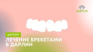 Как работают брекеты? Приходите за ровными зубами в Дарлин!