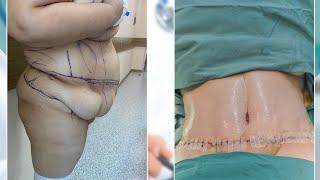 Günün abdominoplastikası Dr. Vusal Abdullayev - Plastik Cərrah